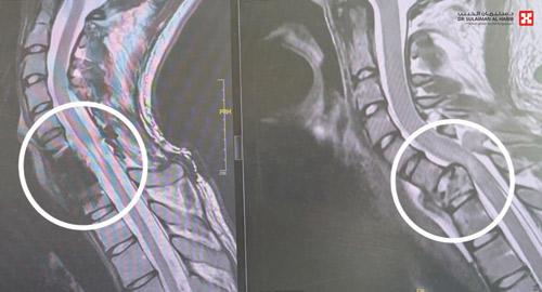 أجرى له عمليتين معقدتين عقب حادث مروري مروع